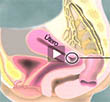 Video<br />Cervical Cancer